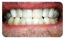TeethWhitening1after_zps42ef1474.jpg TeethWhitening1after_zps42ef1474.jpg