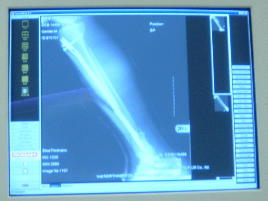 mylegatthehospital009.jpg